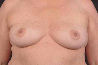 Immediate Breast Reconstruction – Nipple Sparing Before & After Gallery - Patient 424181 - Image 1