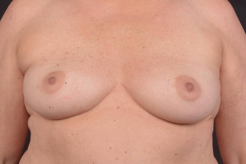 Immediate Breast Reconstruction – Nipple Sparing Before & After Gallery - Patient 424181 - Image 1