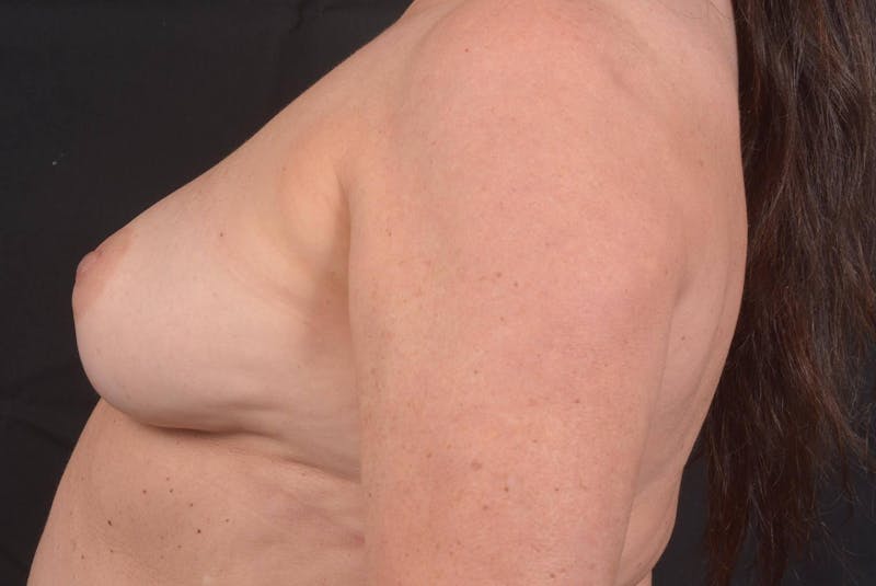 Immediate Breast Reconstruction – Nipple Sparing Before & After Gallery - Patient 424181 - Image 3