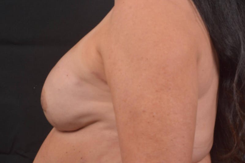 Immediate Breast Reconstruction – Nipple Sparing Before & After Gallery - Patient 424181 - Image 4