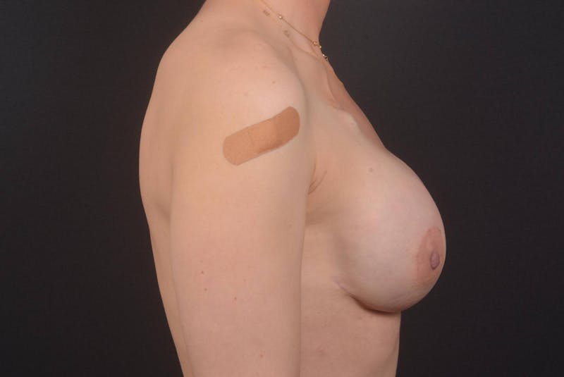 Immediate Breast Reconstruction – Nipple Sparing Before & After Gallery - Patient 958955 - Image 6