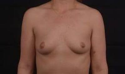 Immediate Breast Reconstruction – Nipple Sparing Before & After Gallery - Patient 418145 - Image 1