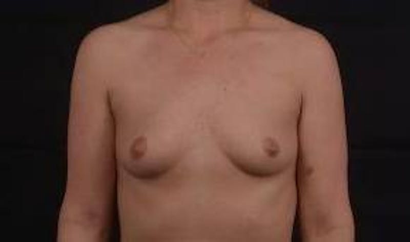 Immediate Breast Reconstruction – Nipple Sparing Before & After Gallery - Patient 418145 - Image 1