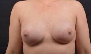 Immediate Breast Reconstruction – Nipple Sparing Before & After Gallery - Patient 418145 - Image 2