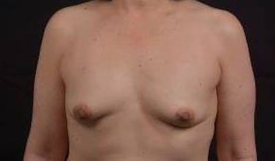 Immediate Breast Reconstruction – Nipple Sparing Before & After Gallery - Patient 133183 - Image 1
