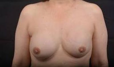 Immediate Breast Reconstruction – Nipple Sparing Before & After Gallery - Patient 133183 - Image 2