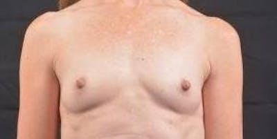 Immediate Breast Reconstruction – Nipple Sparing Before & After Gallery - Patient 331014 - Image 1