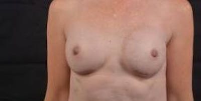 Immediate Breast Reconstruction – Nipple Sparing Before & After Gallery - Patient 331014 - Image 2