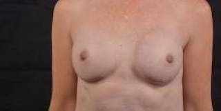 Immediate Breast Reconstruction – Nipple Sparing Before & After Gallery - Patient 331014 - Image 2