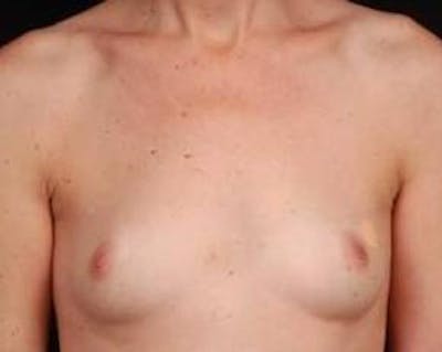 Immediate Breast Reconstruction – Nipple Sparing Before & After Gallery - Patient 275802 - Image 1