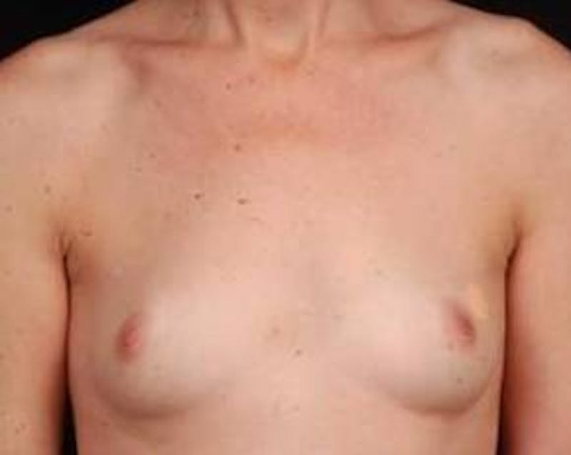 Immediate Breast Reconstruction – Nipple Sparing Before & After Gallery - Patient 275802 - Image 1