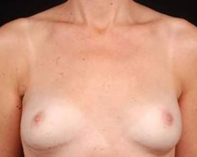 Immediate Breast Reconstruction – Nipple Sparing Before & After Gallery - Patient 275802 - Image 2