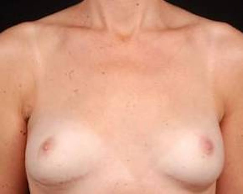 Immediate Breast Reconstruction – Nipple Sparing Before & After Gallery - Patient 275802 - Image 2