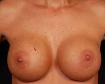 Immediate Breast Reconstruction – Nipple Sparing Before & After Gallery - Patient 267235 - Image 1