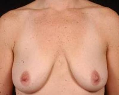 Immediate Breast Reconstruction – Nipple Sparing Before & After Gallery - Patient 420678 - Image 1