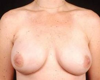 Immediate Breast Reconstruction – Nipple Sparing Before & After Gallery - Patient 420678 - Image 2