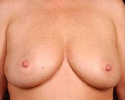 Immediate Breast Reconstruction – Nipple Sparing Before & After Gallery - Patient 357281 - Image 1