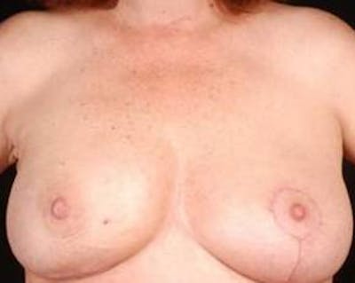 Immediate Breast Reconstruction – Nipple Sparing Before & After Gallery - Patient 357281 - Image 2