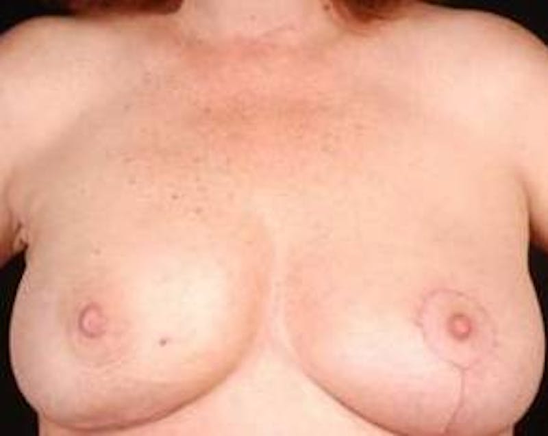 Immediate Breast Reconstruction – Nipple Sparing Before & After Gallery - Patient 357281 - Image 2