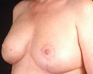 Immediate Breast Reconstruction – Nipple Sparing Before & After Gallery - Patient 357281 - Image 6