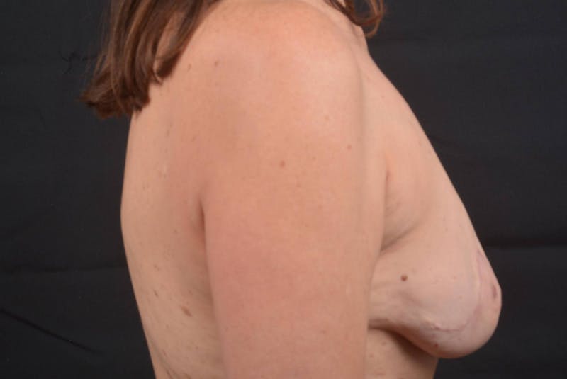 Immediate Breast Reconstruction – Nipple Sparing Before & After Gallery - Patient 397236 - Image 5