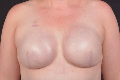 Immediate Breast Reconstruction – Skin Sparing Before & After Gallery - Patient 186303 - Image 2