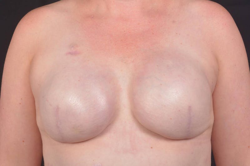 Immediate Breast Reconstruction – Skin Sparing Before & After Gallery - Patient 186303 - Image 2