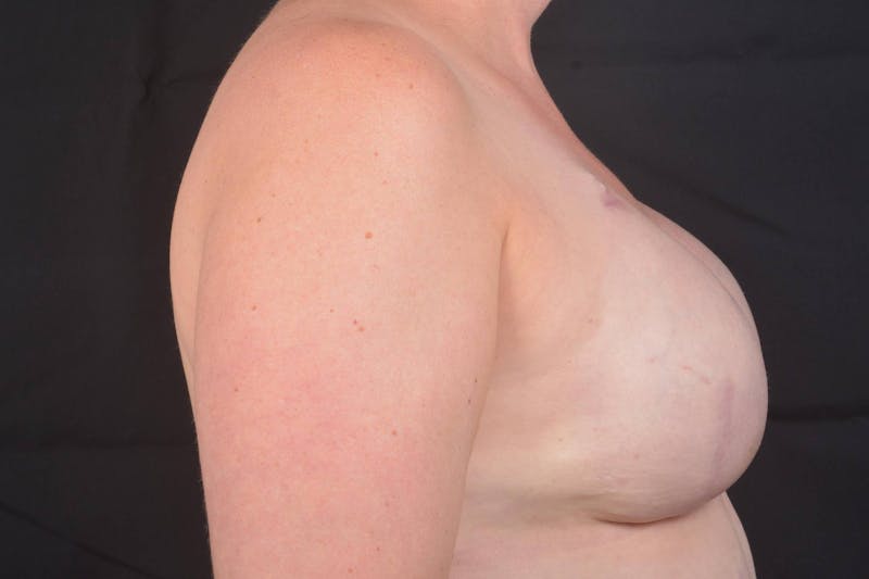 Immediate Breast Reconstruction – Skin Sparing Before & After Gallery - Patient 186303 - Image 6