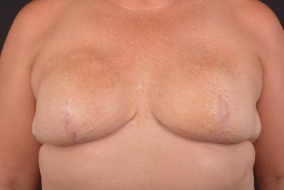 Immediate Breast Reconstruction – Skin Sparing Before & After Gallery - Patient 364612 - Image 2