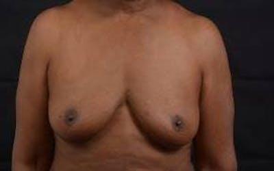 Immediate Breast Reconstruction – Skin Sparing Before & After Gallery - Patient 184310 - Image 1