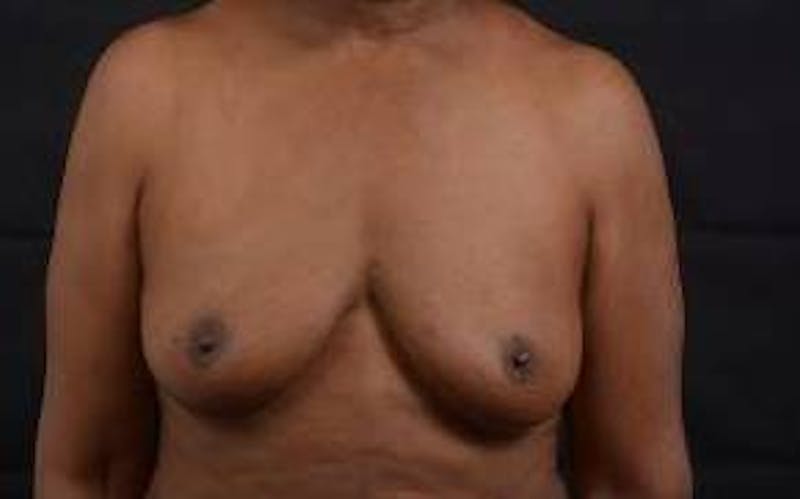 Immediate Breast Reconstruction – Skin Sparing Before & After Gallery - Patient 184310 - Image 1