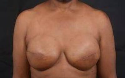 Immediate Breast Reconstruction – Skin Sparing Before & After Gallery - Patient 184310 - Image 2