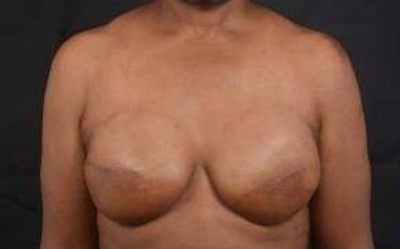 Immediate Breast Reconstruction – Skin Sparing Before & After Gallery - Patient 184310 - Image 2