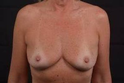 Immediate Breast Reconstruction – Skin Sparing Before & After Gallery - Patient 297506 - Image 1