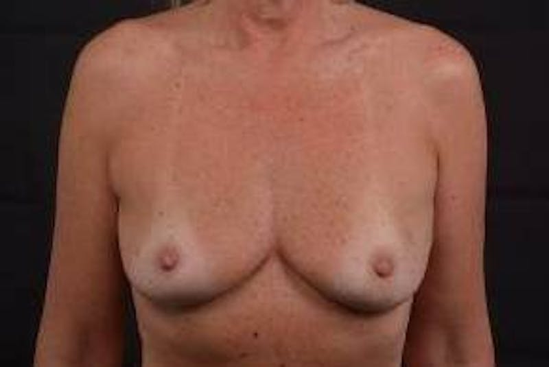 Immediate Breast Reconstruction – Skin Sparing Before & After Gallery - Patient 297506 - Image 1