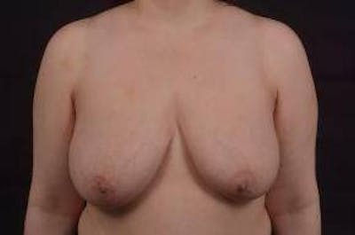 Immediate Breast Reconstruction – Skin Sparing Before & After Gallery - Patient 358522 - Image 1
