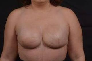 Immediate Breast Reconstruction – Skin Sparing Before & After Gallery - Patient 358522 - Image 2