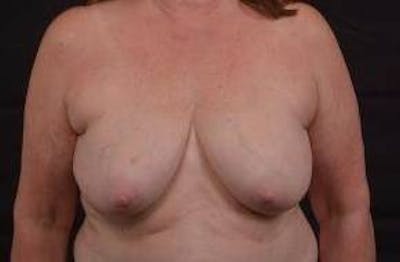 Immediate Breast Reconstruction – Skin Sparing Before & After Gallery - Patient 162765 - Image 1