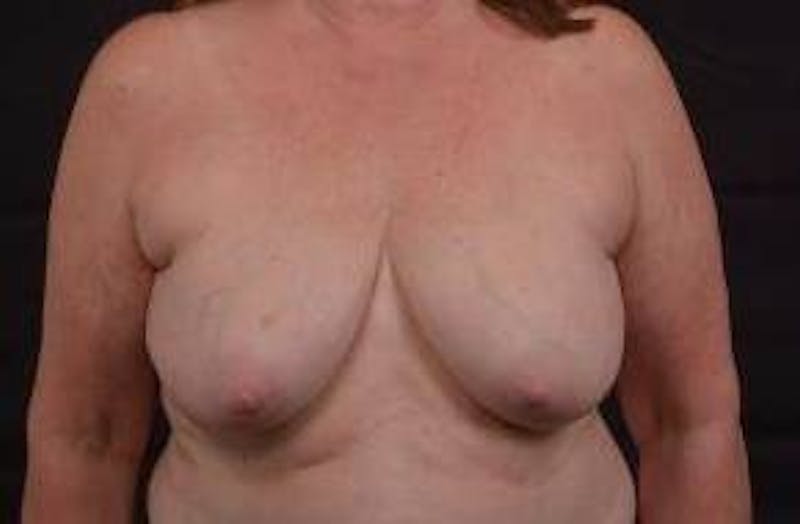 Immediate Breast Reconstruction – Skin Sparing Before & After Gallery - Patient 162765 - Image 1