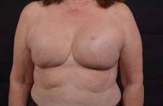 Immediate Breast Reconstruction – Skin Sparing Before & After Gallery - Patient 162765 - Image 2
