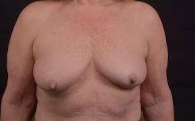 Immediate Breast Reconstruction – Skin Sparing Before & After Gallery - Patient 498308 - Image 1