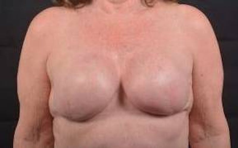 Immediate Breast Reconstruction – Skin Sparing Before & After Gallery - Patient 498308 - Image 2