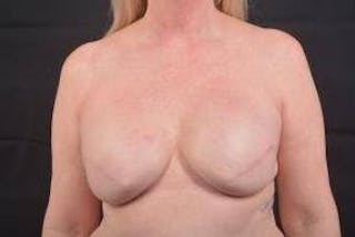 Immediate Breast Reconstruction – Skin Sparing Before & After Gallery - Patient 367060 - Image 2