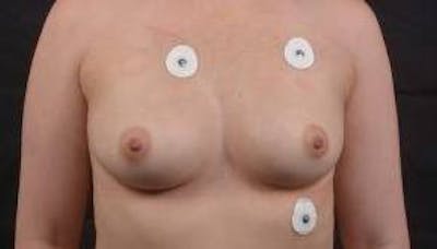 Immediate Breast Reconstruction – Skin Sparing Before & After Gallery - Patient 150575 - Image 1