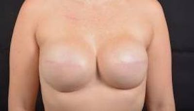 Immediate Breast Reconstruction – Skin Sparing Before & After Gallery - Patient 150575 - Image 2