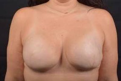 Immediate Breast Reconstruction – Skin Sparing Before & After Gallery - Patient 339397 - Image 2