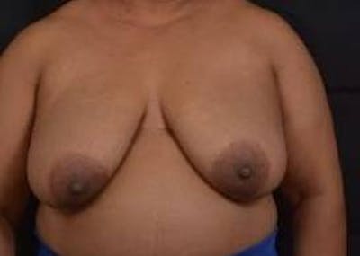 Immediate Breast Reconstruction – Skin Sparing Before & After Gallery - Patient 229008 - Image 1
