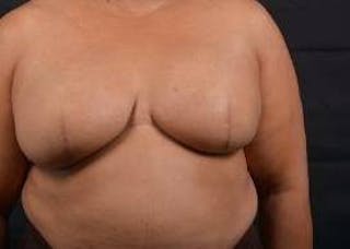 Immediate Breast Reconstruction – Skin Sparing Before & After Gallery - Patient 229008 - Image 2