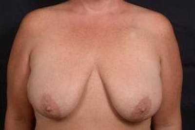 Immediate Breast Reconstruction – Skin Sparing Before & After Gallery - Patient 311958 - Image 1