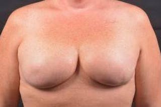 Immediate Breast Reconstruction – Skin Sparing Before & After Gallery - Patient 311958 - Image 2